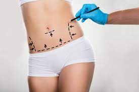 how to get a free tummy tuck surgery