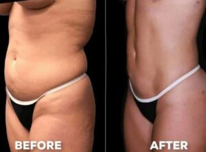 medicaid cover liposuction